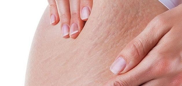 تشققات البطن أثناء الحمل تشققات البطن أثناء الحمل