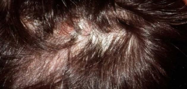 أعراض التهاب بصيلات الشعر وعلاجه أعراض التهاب بصيلات الشعر وعلاجه
