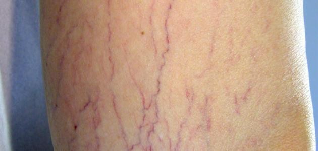 ما هي مضاعفات مرض دوالي الساقين ما هي مضاعفات مرض دوالي الساقين