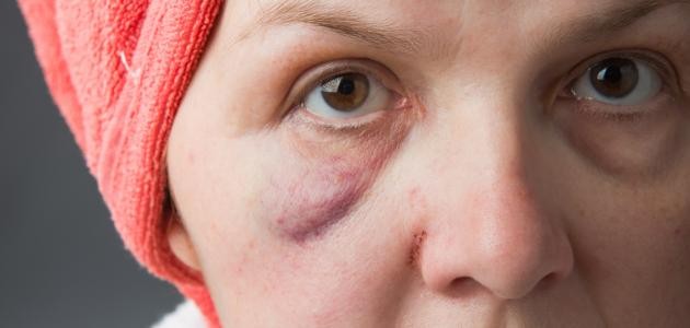 ما أسباب تورم الوجه ما أسباب تورم الوجه