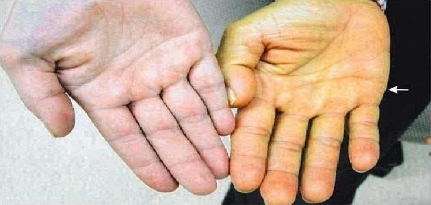 ما هو سبب اصفرار الجسم ما هو سبب اصفرار الجسم