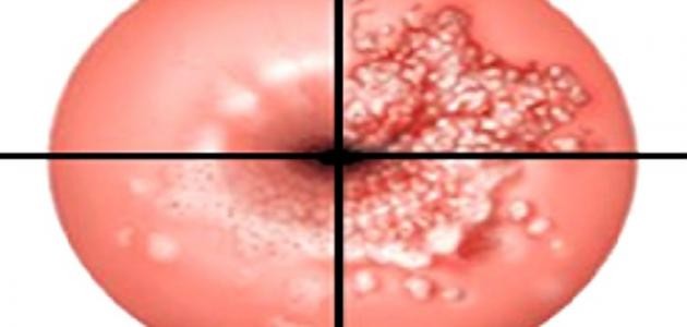 ما هي أعراض قرحة الرحم ما هي أعراض قرحة الرحم