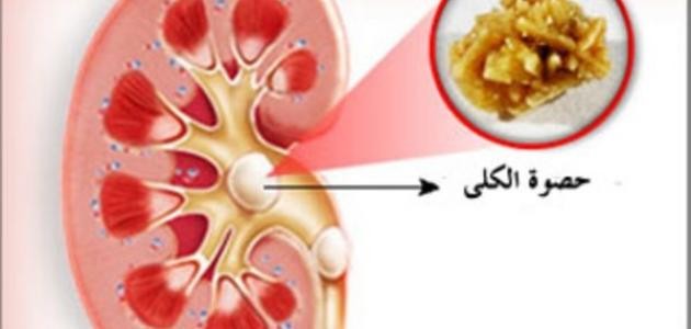 ما هي أعراض رمل الكلى ما هي أعراض رمل الكلى