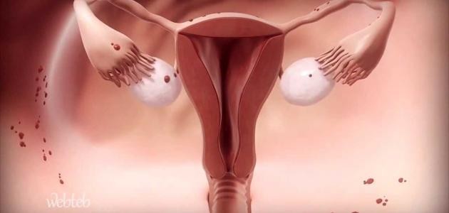 ما هو احتقان الرحم