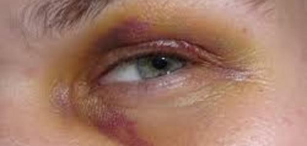 كيفية علاج الرضوض كيفية علاج الرضوض