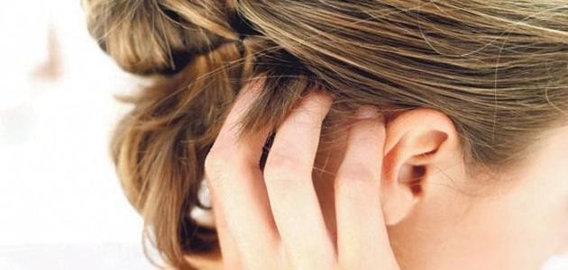 ما علاج حساسية فروة الرأس