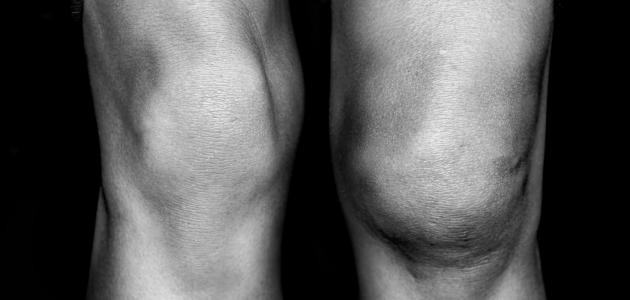 ما هي أسباب تورم الرجلين