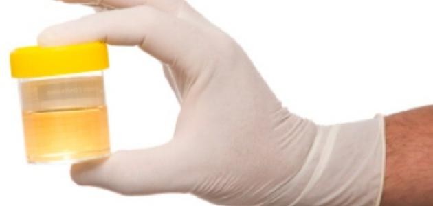 ما هو زلال البول عند الحامل ما هو زلال البول عند الحامل