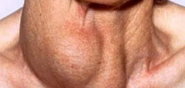 ما علاج تضخم الغدد اللمفاوية ما علاج تضخم الغدد اللمفاوية
