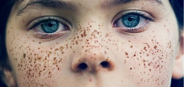 كيف أقضي على الكلف كيف أقضي على الكلف