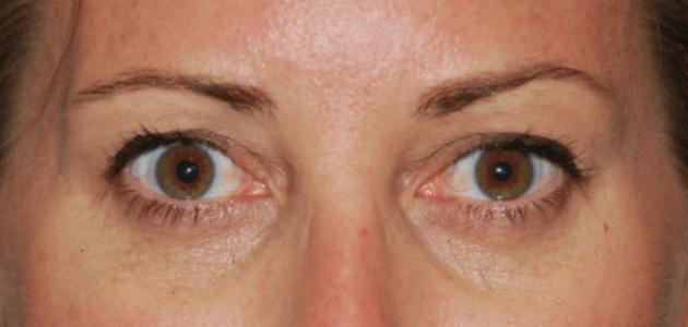 ما هو الوهن العضلي