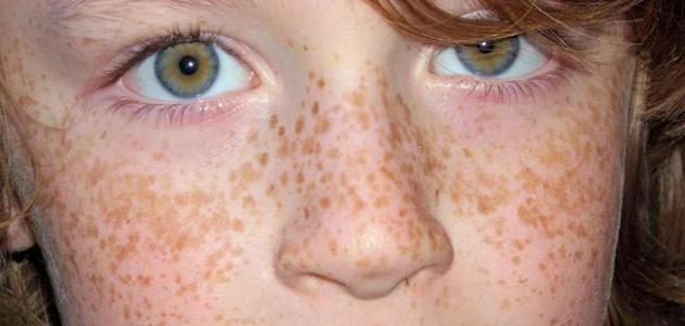 طريقة إزالة الكلف والنمش من الوجه طريقة إزالة الكلف والنمش من الوجه