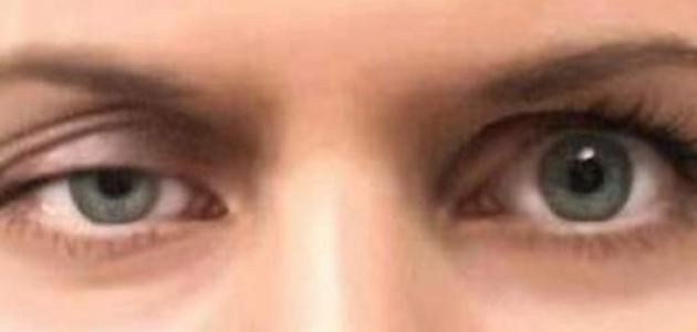 الغدة الدرقية وأمراض العين الغدة الدرقية وأمراض العين