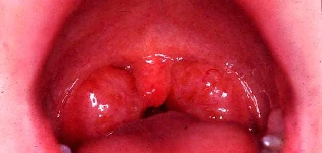 ما هو ميكروب الدم