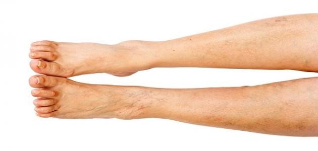 طريقة علاج الدوالي بخل التفاح