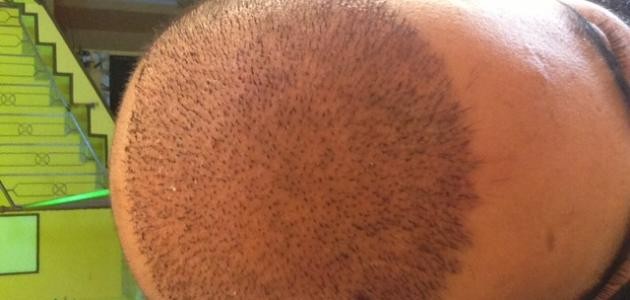 ما بعد زراعة الشعر ما بعد زراعة الشعر