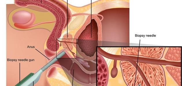 ما هو تليف البروستاتا