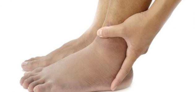 ما أسباب تورم الساقين ما أسباب تورم الساقين