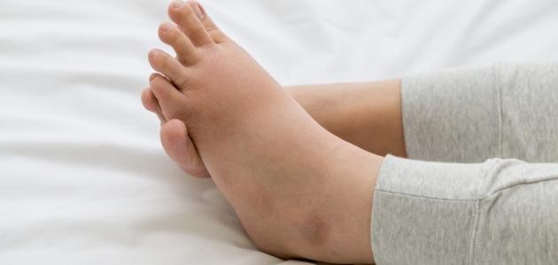 ما هي أسباب تورم القدم