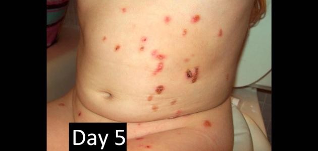 المليساء المعدية المليساء المعدية