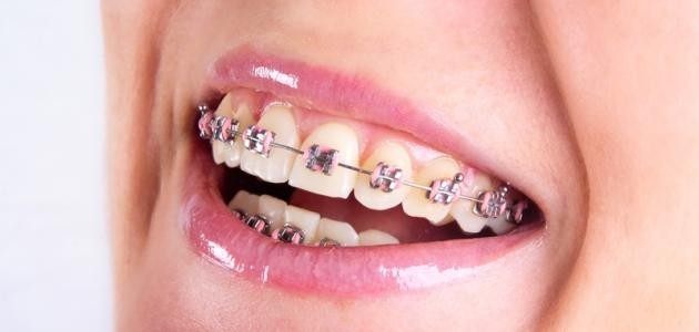 كيفية العناية بتقويم الأسنان كيفية العناية بتقويم الأسنان