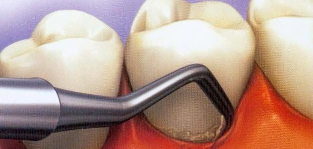 طريقة تنظيف اللثة طريقة تنظيف اللثة