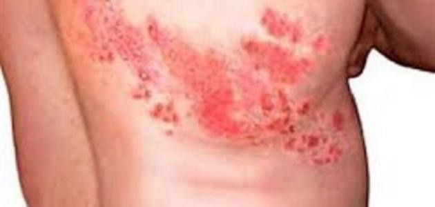 ما هي أعراض الحزام الناري