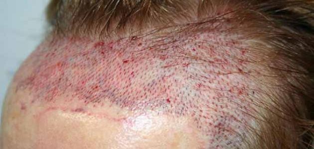 مراحل زراعة الشعر مراحل زراعة الشعر