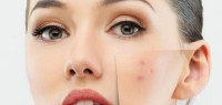 كيف أزيل الحبوب بأسرع وقت كيف أزيل الحبوب بأسرع وقت