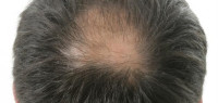 الصلع وزراعة الشعر الصلع وزراعة الشعر