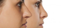 عمليات تجميل الأنف