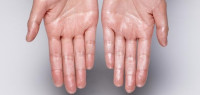 كيف أتخلص من تعرق اليدين كيف أتخلص من تعرق اليدين