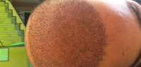 ما بعد زراعة الشعر ما بعد زراعة الشعر