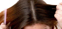 كيف أزيل القشرة من الشعر كيف أزيل القشرة من الشعر
